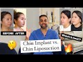 Chin Implant vs. Chin Lipo