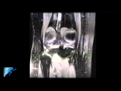 Videó: Osteochondritis Dissecans (OCD) Kutyáknál