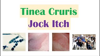 Jock Itch (Tinea Cruris) | Causes, Risk Factors, Signs \& Symptoms, Diagnosis and Treatment