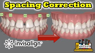 Teeth Spacing correction using Invisalign - Corrected with out Braces
