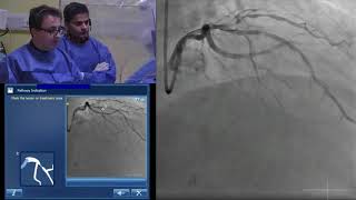 iFR Co-Registration and Virtual Angioplasty