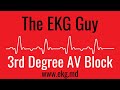 Third Degree AV Block EKG l The EKG Guy - www.ekg.md