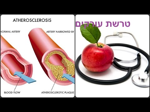 המסת טרשת עורקים, טיפול לניקוי העורקים והשומנים בדם, טרשת עורקים טיפול טבעי, פתיחת עורקים סתומים