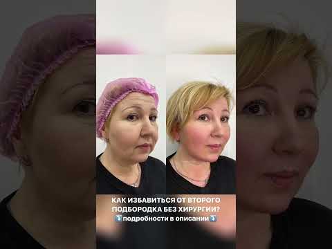 Как избавиться от второго подбородка без хирургического вмешательства?