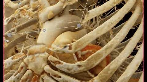 Parathyroid Adenoma with Cinematic Rendering