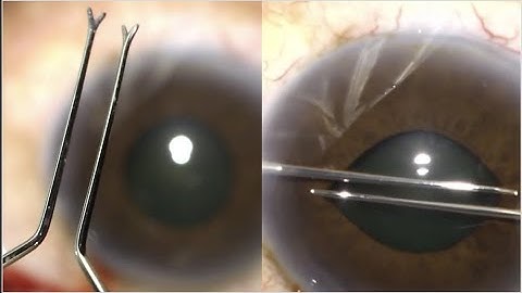 The Technique of Stretch pupilloplasty