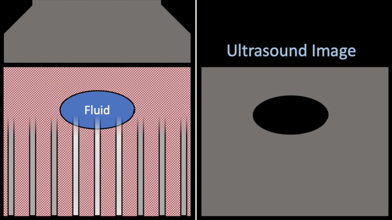 Posterior acoustic enhancement YouTube