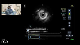 How to make complex PCI safe, simple, effective with new angiography imaging guidance - EuroPCR 2024