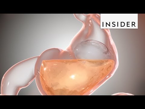 How a Stomach Balloon Makes People Lose Weight