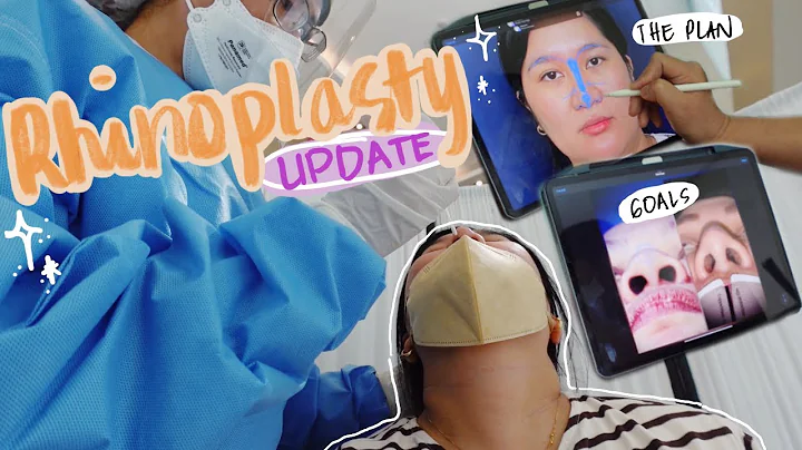 RHINOPLASTY UPDATE ( Napiling Surgeon, Date and Pr...