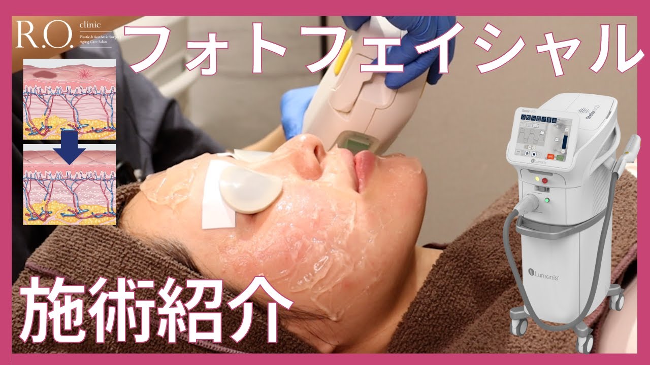 【フォトフェイシャル解説】赤ら顔や、ニキビ跡の赤み、くすみ、など効果様々！〜美肌の持ち主が定期的に行なっている施術NO,1！〜