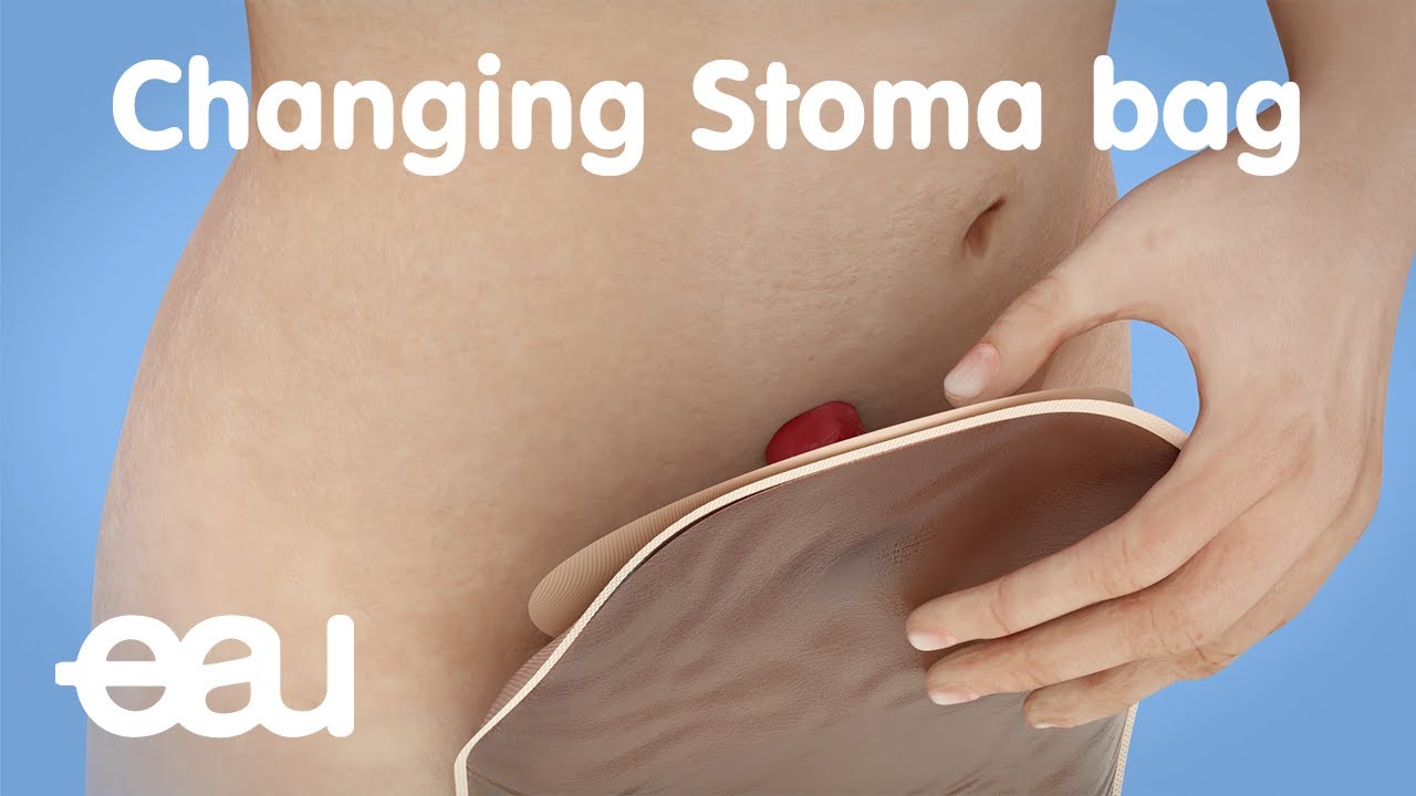 How Do I Dispose Of My Stoma Bag? | CliniMed