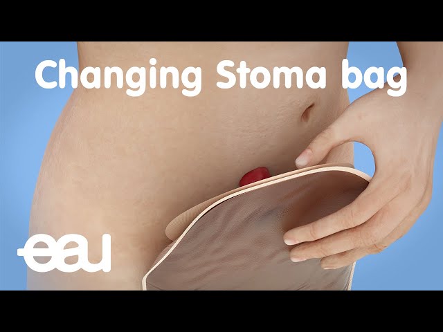 Colostomy/Ileostomy: Emptying a Pouch - YouTube