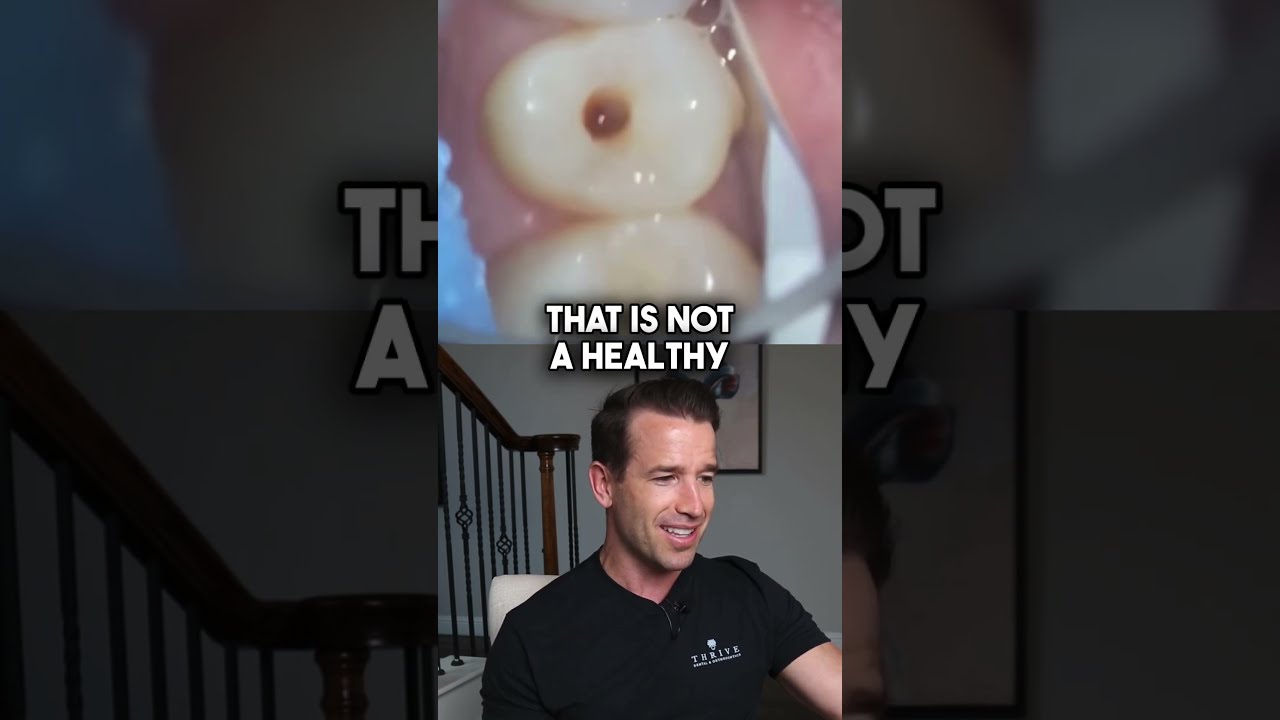 Small Spot Turns Into A Monster Shorts Dentalcavity Dentist