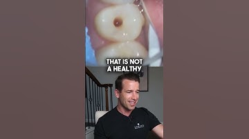 Small Spot turns into a Monster #shorts #dentalcavity #dentist