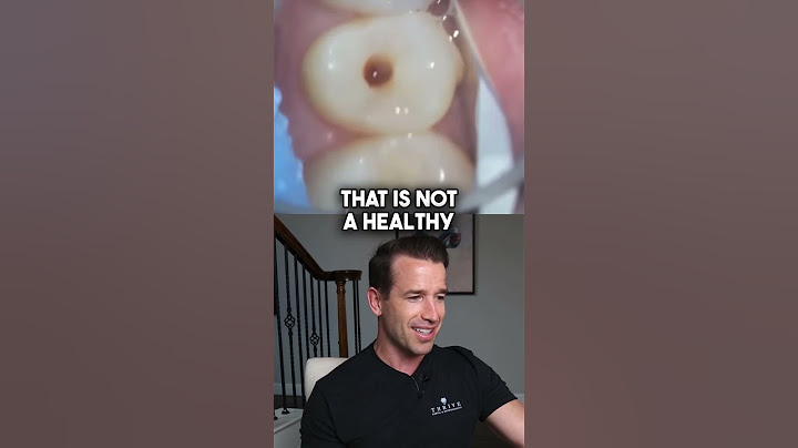 Small Spot turns into a Monster #shorts #dentalcavity #dentist