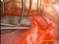 Trabeculectomy Revision Left eye