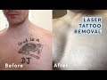 Laser Tattoo Removal - Before and After through all the stages