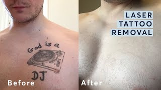 Does Laser Tattoo Removal leave Scars or Blisters  Orange Coast Aesthetics