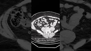 How I read CT Abdomen pelvis