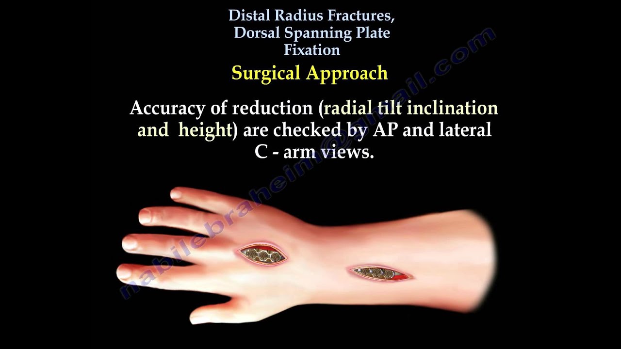 Distal Radius fracture , Dorsal Spanning Plate