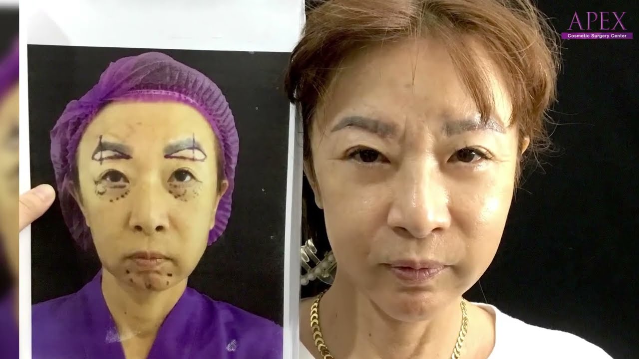 Review sub brow Lift Michie Sakai from Japan