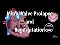 Mitral Valve Prolapse and Regurgitation, Animation