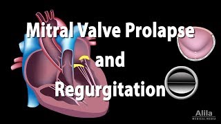 Mitral Valve Prolapse and Regurgitation, Animation