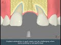 Implant restoration option 2  smile guru