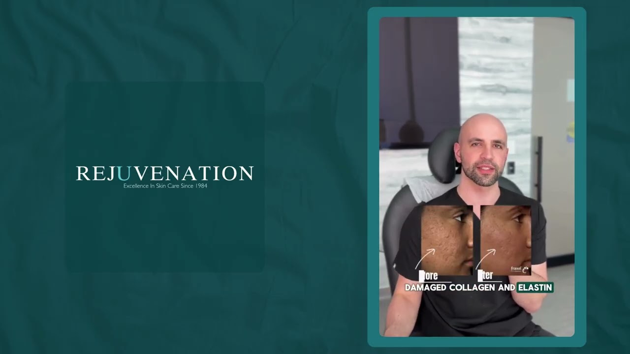 Acne Scars + Fraxel: A Clearer Path to Smoother Skin