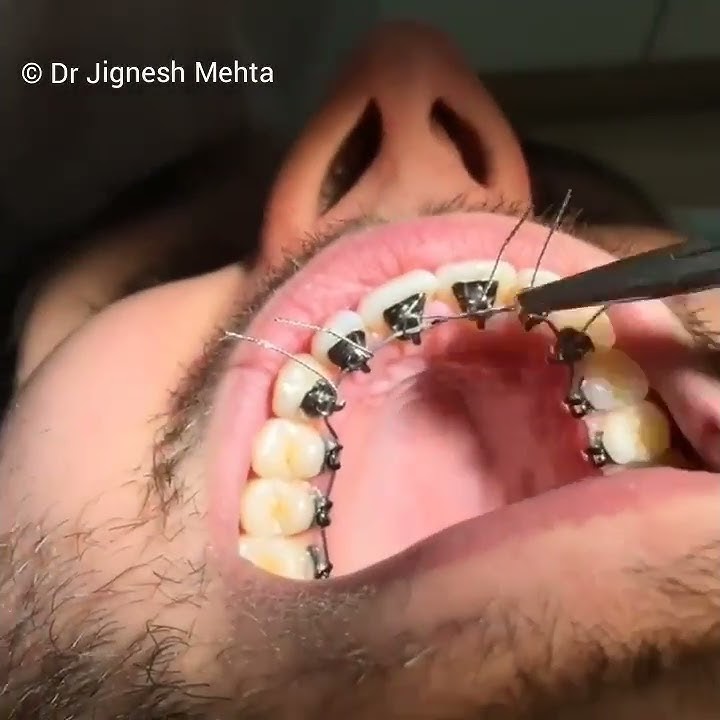 Lingual Braces, Teeth Clip, Invisible Braces