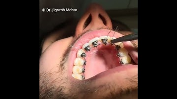 Lingual Braces, Teeth Clip, Invisible Braces