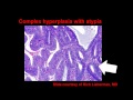 Topic 54: Endometrial Hyperplasia and Carcinoma