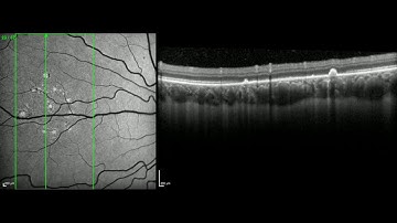 Optical coherence topography (OCT) through the nasal chorioretinal lesions