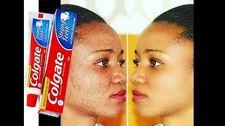 Njia Rahisi ya kuondoa MABAKA,CHUNUSI usoni kwa kutumia COLGATE na LIMAO