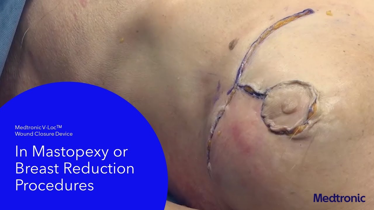 Surgical incisions for reduction mammoplasty. (a) An incision is