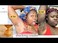 3 ways to Use Honey to Lighten Your Under Arm Super Fast. Before and After Result