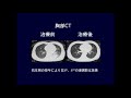 肺炎