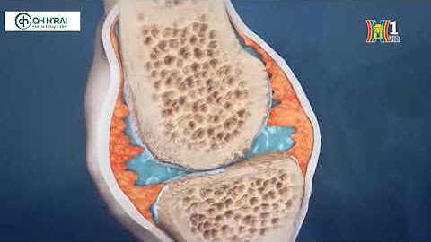 Làm sao để phòng tránh đau nhức xương khớp khi thời tiết thay đổi?