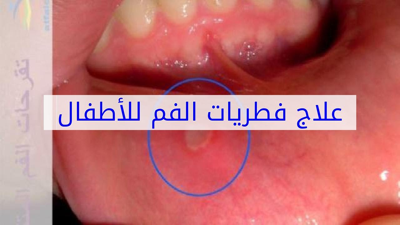 علاج فطريات الفم عند الاطفال الصغار