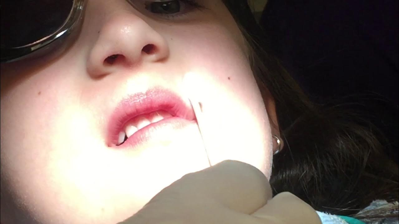 Superfloss SDF Tutorial for interproximal cavities using Advantage ...