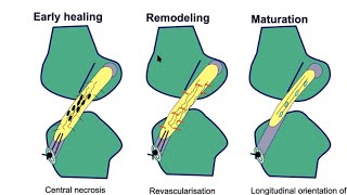 ACL Injuries