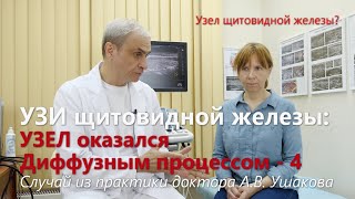 УЗИ щитовидной: Узел оказался Диффузным процессом! Пункция и Биопсия не нужны! /// Доктор Ушаков