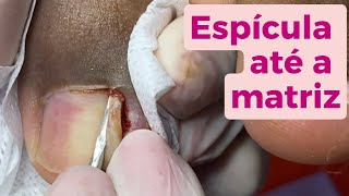 Espícula até a matriz  [Renata Werneck Podóloga Unha Encravada REMOVE INGROWN NAIL]