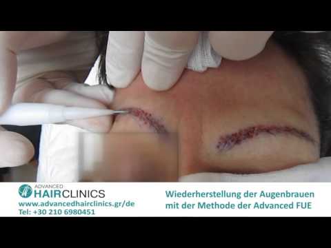 Video: Augenbrauentransplantation: Verfahren, Kosten, Vor- Und Nachteile, Vorsichtsmaßnahmen