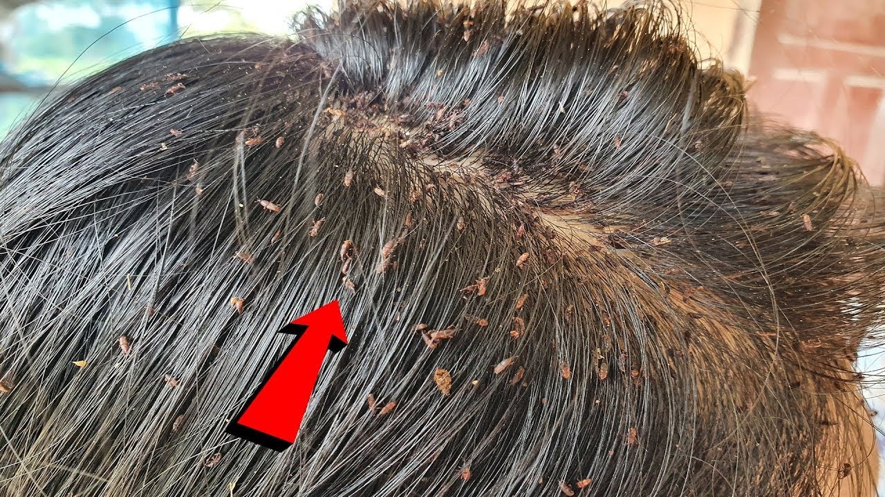 Thousand Big Lice On Mum Head Head Lice Removal Lice Comb YouTube