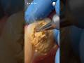 Yellow to Black 😬 | Plaque to Severe Decay Removal | Satisfying Dental Cleaning &amp; Restoration #ai