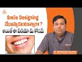 Complete guide for smile designing in telugu  dr m charan kumar  eledent dental hospitals