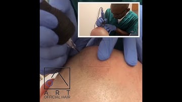 Dallas Scalp Micropigmentation (SMP) Close-Up