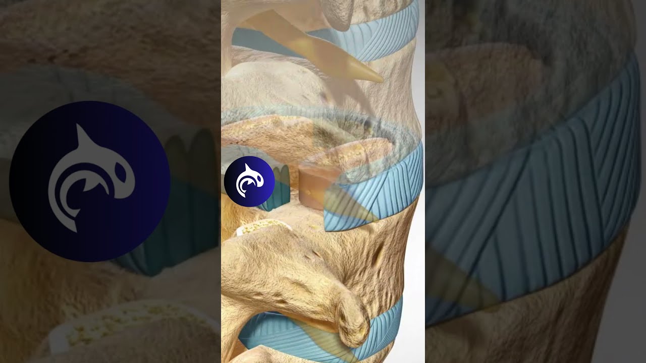 See How A Lumbar Fusion Can Fix Spondylolisthesis Of The Spine 3D Animation Backpain